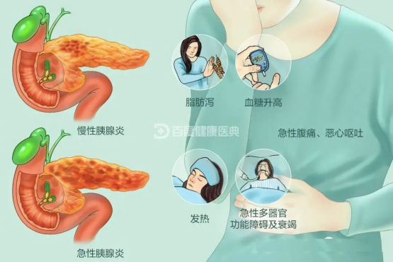 【健康科普】飲食不當(dāng)，當(dāng)心會(huì)要命的急性胰腺炎208.png