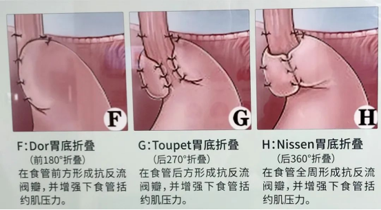 老太反復(fù)咳嗽、嘔吐5年，原因竟是“食管裂孔疝”！市二院普外二科腹腔鏡微創(chuàng)手術(shù)速解難題1220.png