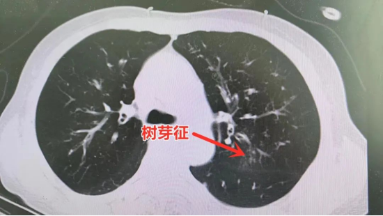 “哮喘”多年，終于揪出真正元兇！市二院呼吸內(nèi)科成功診治一例ABPA患者546.png