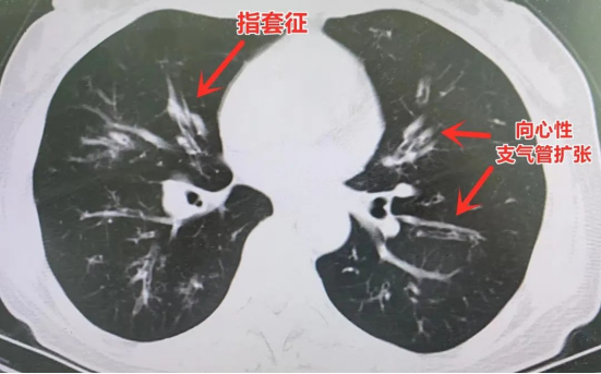 “哮喘”多年，終于揪出真正元兇！市二院呼吸內(nèi)科成功診治一例ABPA患者548.png