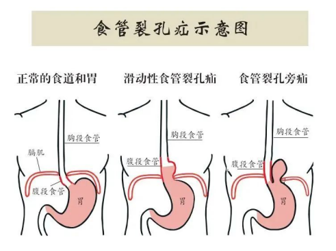 老太反復(fù)咳嗽、嘔吐5年，原因竟是“食管裂孔疝”！市二院普外二科腹腔鏡微創(chuàng)手術(shù)速解難題1737.png