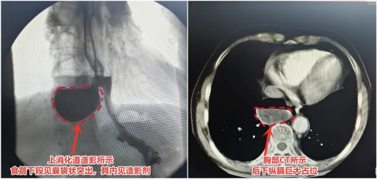 食管竟“塌陷”出6cm×5cm深坑！市二院胸心外科完成一例胸腔鏡下巨大食管憩室切除術(shù)2589.png